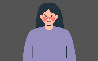 Lupus Treatment