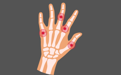 Arthritis Treatment