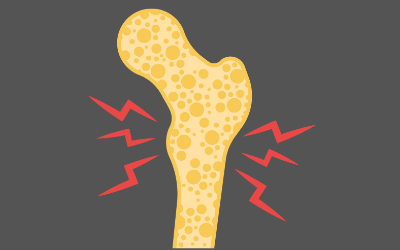 Osteoporosis Management<br />
