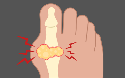 Gout Treatment