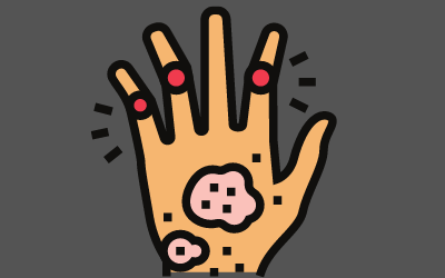 Scleroderma Care